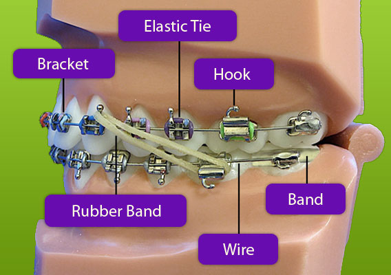 Braces Diagram Berkman & Shapiro Orthodontics, Commerce Township, MI 48382