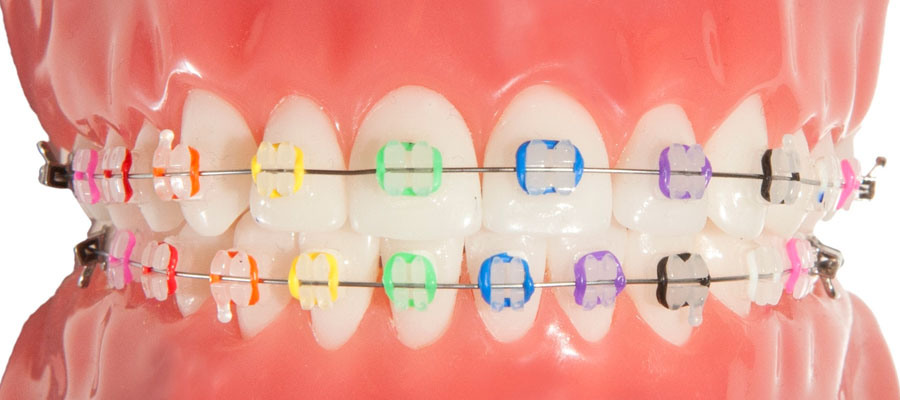 invisible braces with color