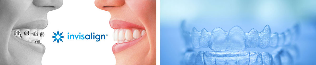 Invisalign Collage at Berkman & Shapiro Orthodontics, Commerce Township, MI 48382