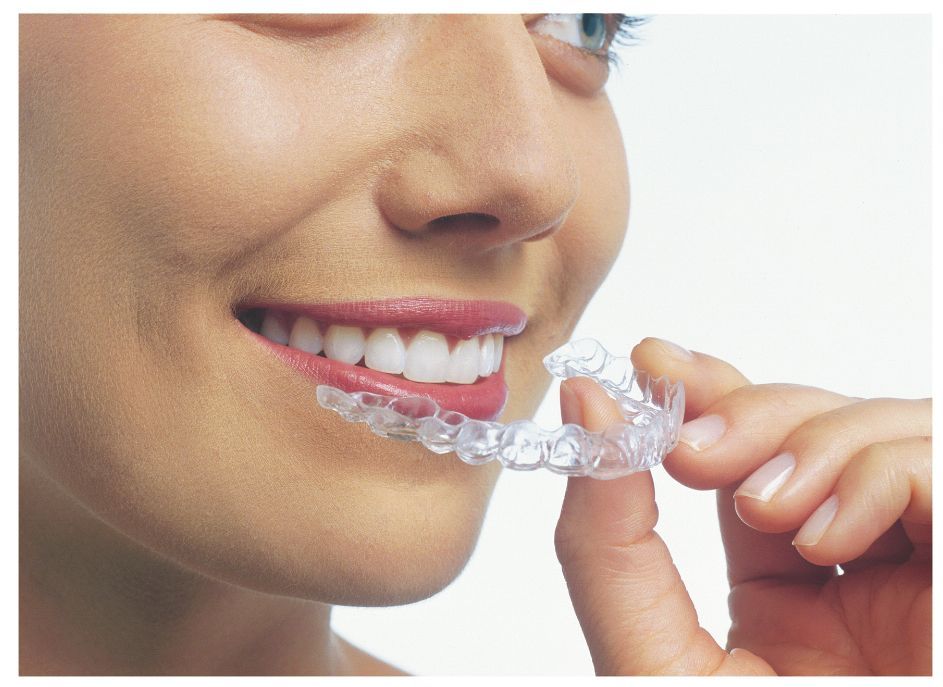 Berkmaninvisalign (2)