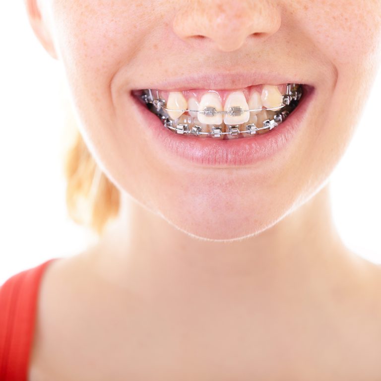 smiling girl with crooked teeth in braces