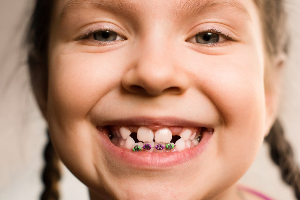 Girl With Dental Braces Berkman And Shapiro Orthodontics Serving