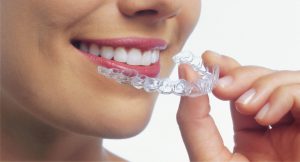 Woman holding Invisalign aligner