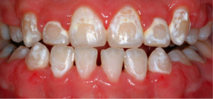 Decalcified teeth caused by poor brushing and oral hygiene habits