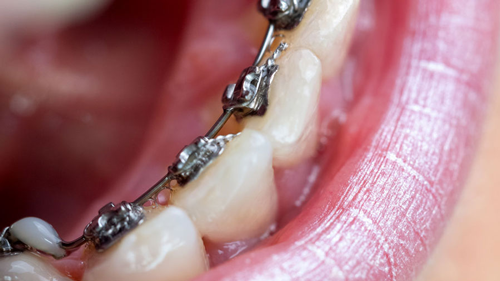 Braces In Commerce Township Mi Berkman And Shapiro Ortho