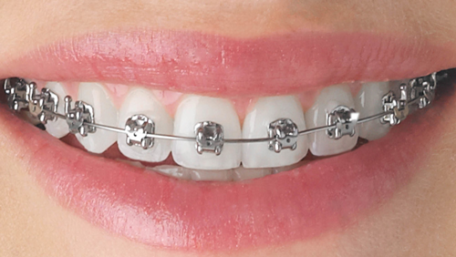 Modern Metal Braces, Parma, OH, Andrew Skorobatckyj, DDS