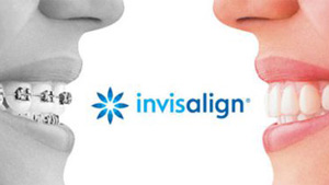 Invisalign Clear Aligners Berkman Shapiro Orthodontist 300px