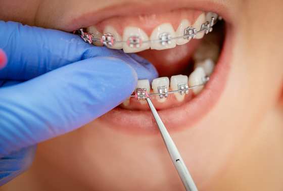 3 Common Braces Struggles And Their Solutions Berkman Shapiro Outstanding Orthodontics