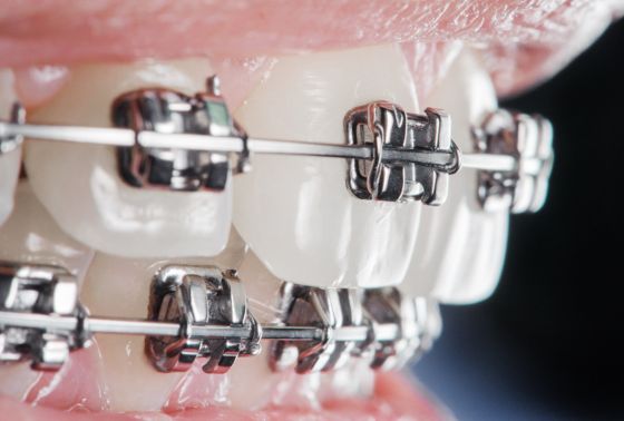 Orthodontic Treatment Dispelling Top 5 Myths And Misconceptions Berkman Shapiro Outstanding Orthodontics
