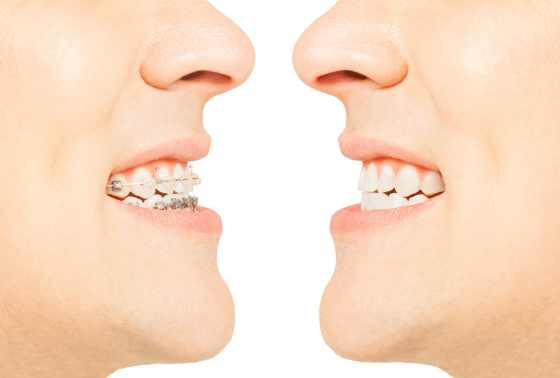 Lexington Aligners