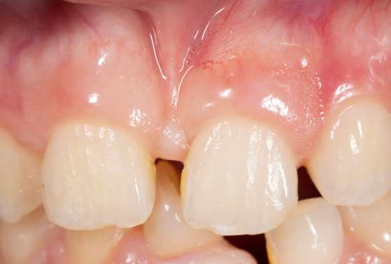 What Is A Frenectomy Everything You Need To Know Berkman Shapiro Outstanding Orthodontics