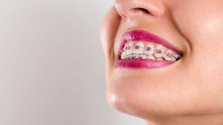 Eight Benefits Of Orthodontic Braces