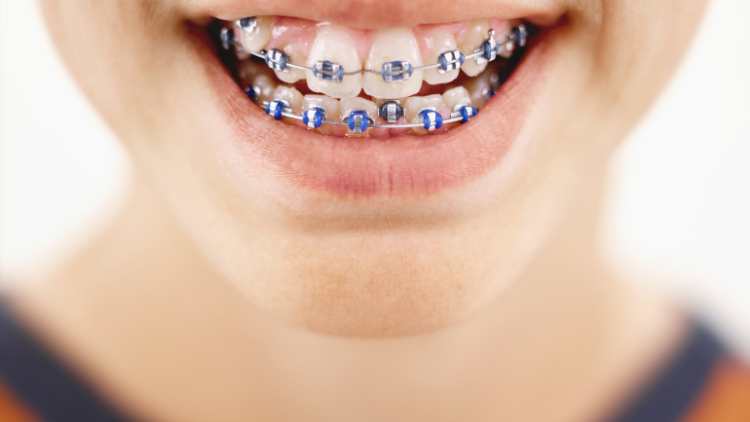 Common Orthodontic Issues In Children