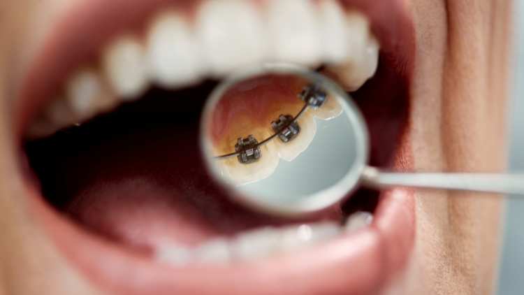 What Are Lingual Braces And Who Are They For