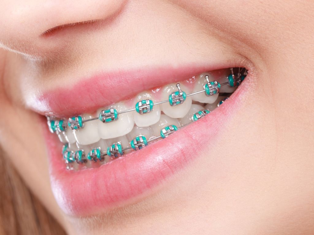best braces colors