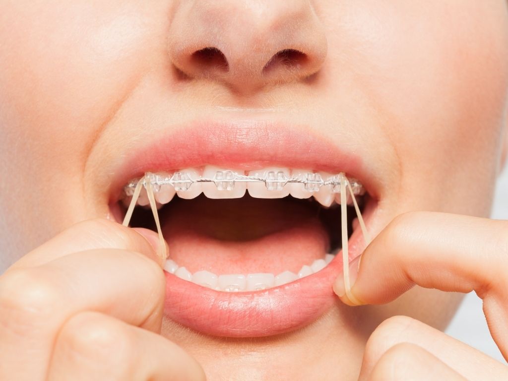 Close-up of a patient wearing clear braces and orthodontic elastics, showing what do rubber bands do for braces and how they help align the bite.