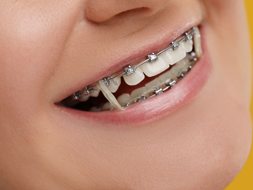 Close-up of braces with orthodontic rubber bands, illustrating what do rubber bands do for braces and how they help correct bite alignment.
